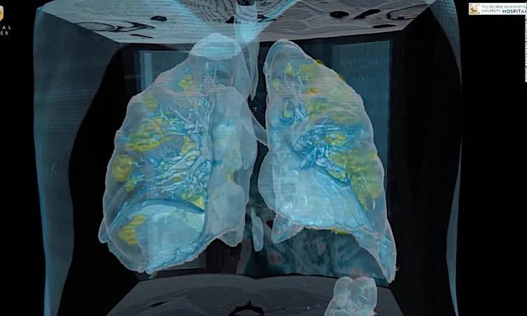 Video reveals lung damage in US coronavirus patient: 'People need to take this seriously'