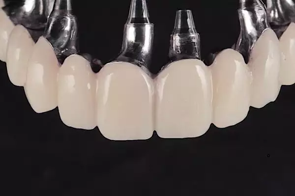 Why You Should Consider Screwless Dental Implants for Your Future