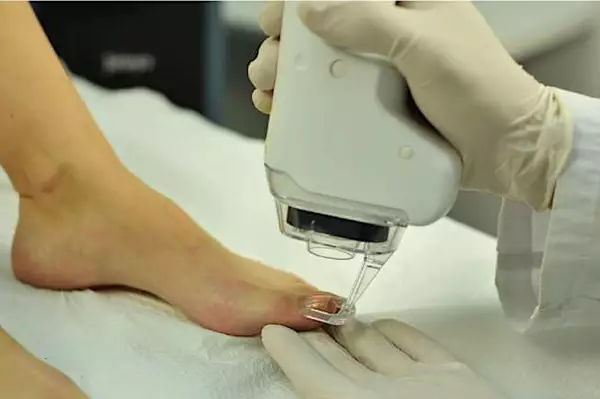 Μάθε πώς φεύγουν οι μύκητες από τα νύχια Μάθε πώς φεύγουν οι μύκητες από τα νύχια