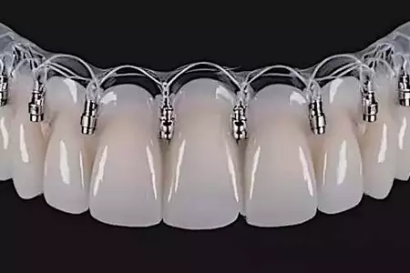 Che cosa sono gli impianti dentali senza viti e quanto costano a Rabat? Che cosa sono gli impianti dentali senza viti e quanto costano a Rabat?