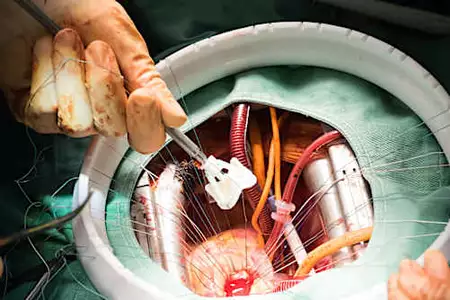 Latest Aortic Valve Replacement Surgery Options - (Know More)