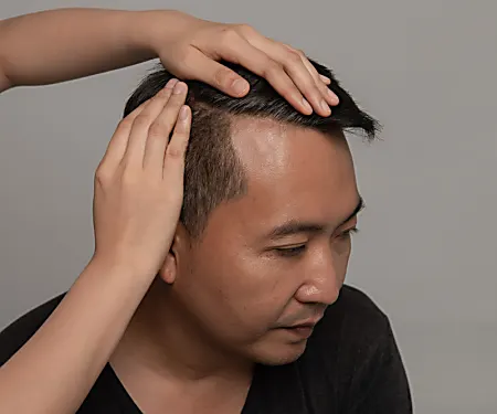 Το πραγματικό αποτέλεσμα της μεταμόσχευσης μαλλιών το 2021 για να εκθέσετε