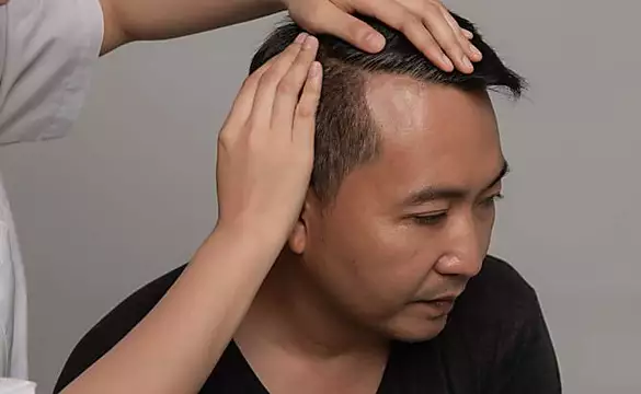 Το πραγματικό αποτέλεσμα της μεταμόσχευσης μαλλιών το 2021 για να εκθέσετε