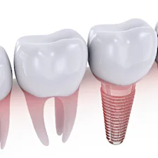 インプラントは絶対ダメ?20名の歯科医師監修のガイドブックを無料公開中 インプラントは絶対ダメ?20名の歯科医師監修のガイドブックを無料公開中