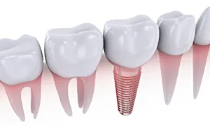 インプラントは絶対ダメ?20名の歯科医師監修のガイドブックを無料公開中 インプラントは絶対ダメ?20名の歯科医師監修のガイドブックを無料公開中