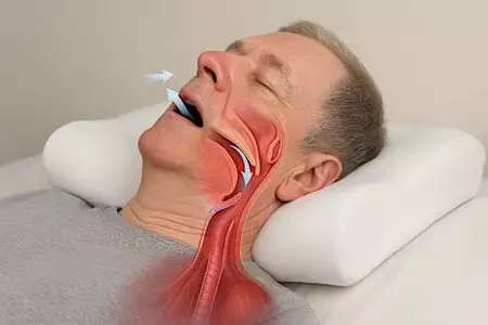 שיטה מס' 1 להקלה על נחירות