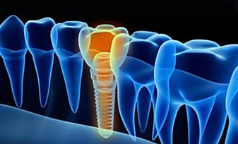 Do You Know The Cost Of Dental Implants in Pleasant Hill?
