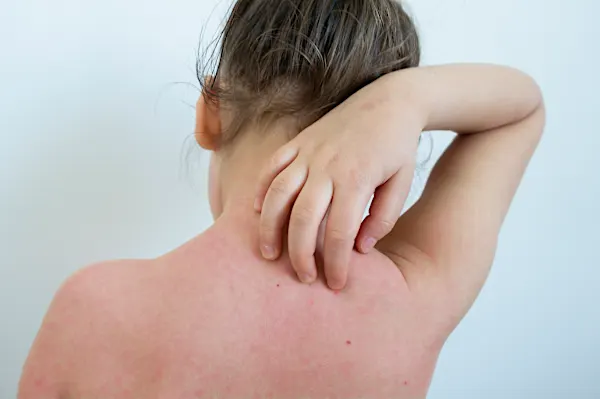 Eczéma : savez-vous tout ?