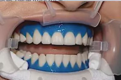 Τι καλύπτει ο ΕΟΠΥΥ για εμφυτεύματα δοντιών στην Ελλάδα