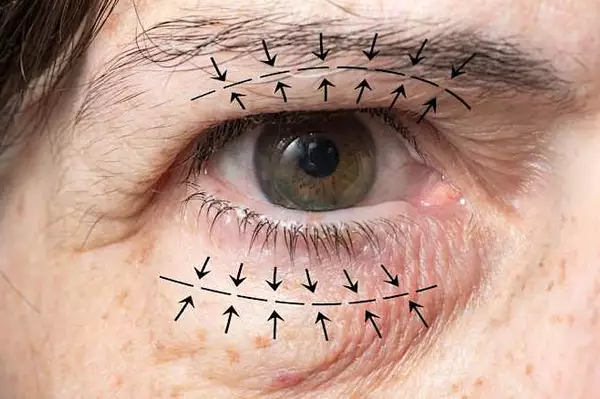 Βλεφαροπλαστική: δείτε την τιμή της επέμβασης το 2026