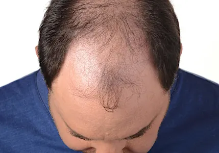 Cresce cabelo nas entradas! Anvisa libera extrato que acaba com 89% da calvície