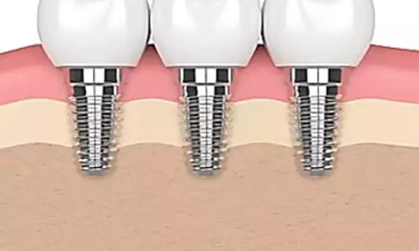 Here Is What New Dental Implants Should Cost You in Toronto