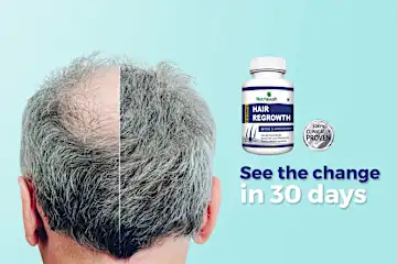 Forget Hair Surgery! Don't Waste Your Money Do This Instead!