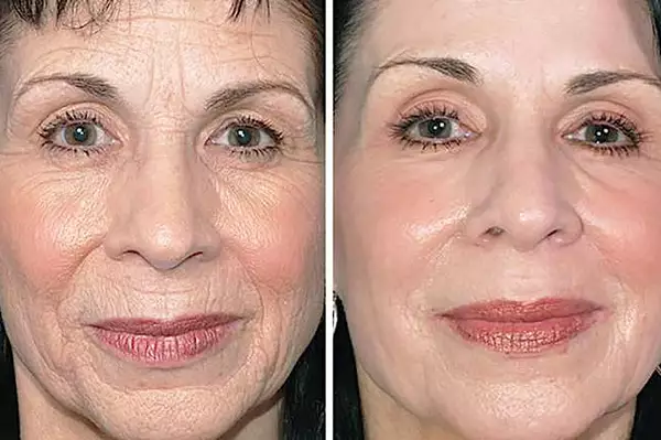 Αν έχετε ρυτίδες στο πρόσωπό σας, δείτε τι πρέπει να κάνετε πριν κοιμηθείτε Αν έχετε ρυτίδες στο πρόσωπό σας, δείτε τι πρέπει να κάνετε πριν κοιμηθείτε