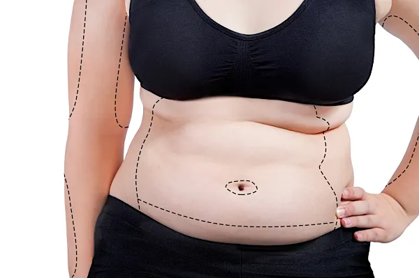 Liposuction In Mexico: Prices May Surprise You!