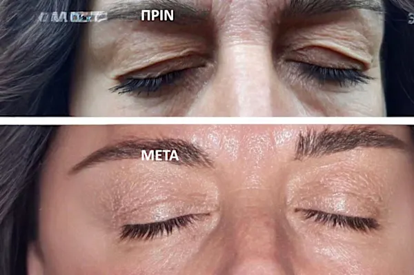 Βλεφαροπλαστική στο Athens: δείτε την τιμή της θεραπείας το 2025