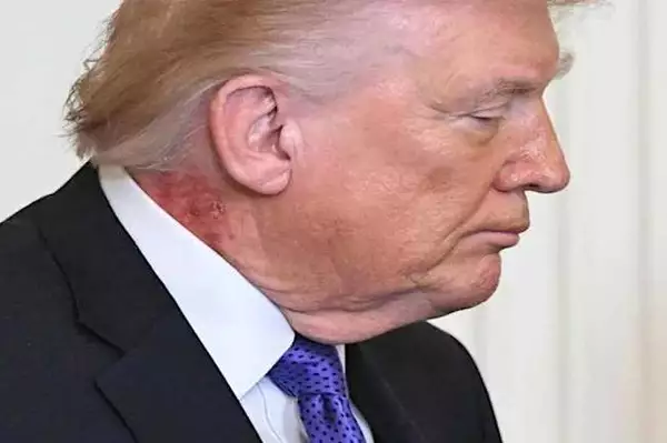 La malattia di Trump svelata dalla foto: tutti l'hanno notato