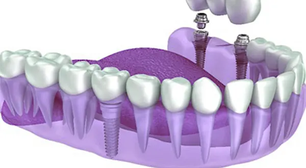 Aparência e sensação de dentes de verdade: aqui estão os preços