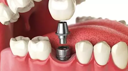 Dental Implants Used to Be Expensive - Not Anymore?