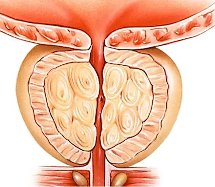 Urologist: Try This If You Have Enlarged Prostate (Watch) Urologist: Try This If You Have Enlarged Prostate (Watch)