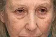 Poches sous les yeux ? Essayez ça chez vous