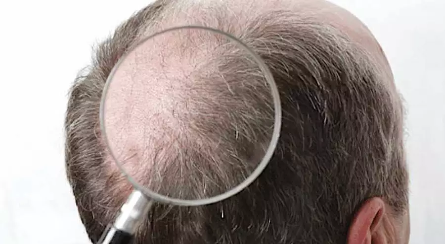 Anvisa libera Minoxidil em pílulas que cresce 4 mil fios por semana