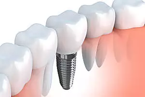 Need Dental Implants But Have No Money? The Cost Might Surprise You