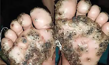 Tungiasis: la infección que ha poblado de pulgas los pies de una niña de 10 años