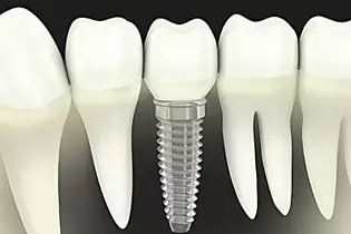 See What Full Mouth Dental Implants Should Cost in 2021