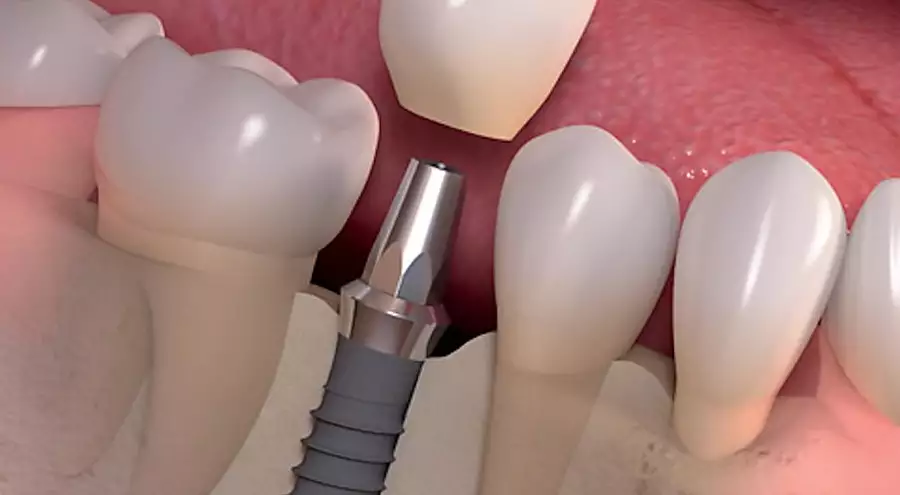 El precio de los implantes dentales en Colon podría sorprenderte