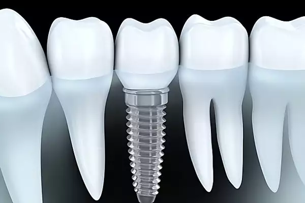 Δείτε τι θα σας κοστίσουν τα οδοντικά εμφυτεύματα με πλήρες στόμα το 2022