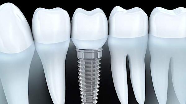 Dental Implants For Seniors Are Paid By Medicare in Accra. (See How)