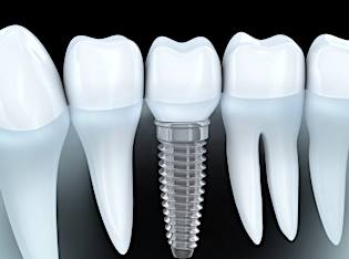 Here's what full mouth dental implants should cost you in 2022