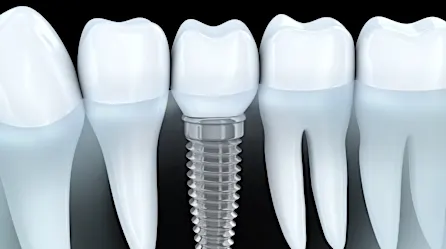 Dental Implants For Seniors Are Paid By Medicare in Caracas. (See How)