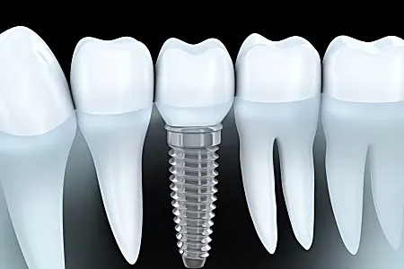 The Cost Of One Day Full Mouth Dental Implants in 2022 Might Surprise You