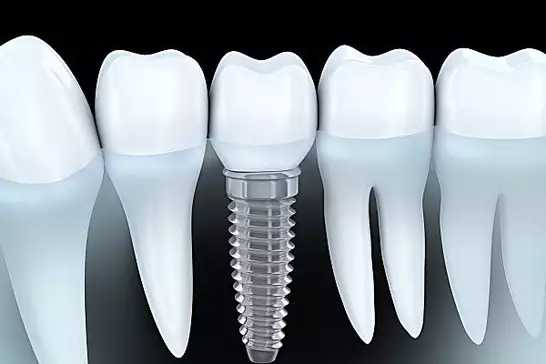 Dental Implants For Seniors Are Paid By Medicare in Ho Chi Minh City. (See How)