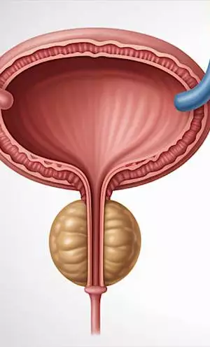 Enlarged Prostate Has Nothing To Do With Age: Just Stop Doing This One Common Thing