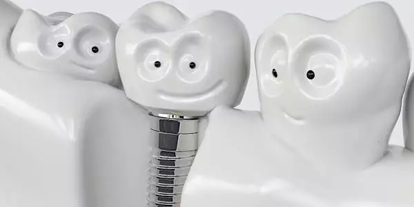 O custo dos implantes dentários pode surpreendê-lo