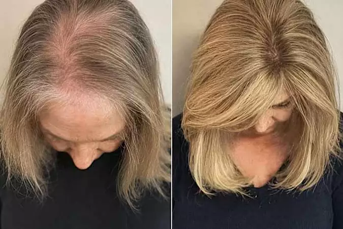 Bald for Years? This Simple Kitchen Ingredient Is Turning Heads