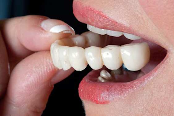 Here Is What Full Mouth Dental Implants Should Cost You in 2021 Here Is What Full Mouth Dental Implants Should Cost You in 2021