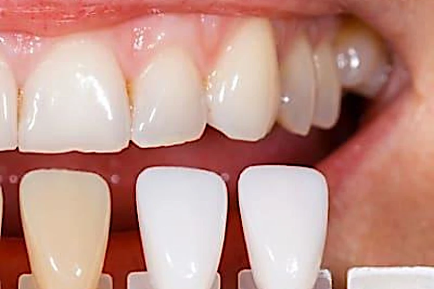 The Mouth Dental Implants in 2023 Might Surprise You (See Offers)