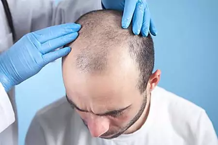 Johannesburg: The Cost Of Hair Transplant In 2022 Might Surprise You