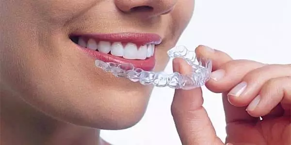 Aparelho ortodôntico - os preços podem surpreendê-lo