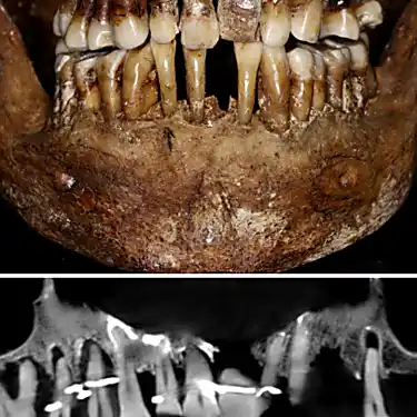 Το χρυσό οδοντιατρικό μυστικό του Γάλλου αριστοκράτη αποκαλύφθηκε 400 χρόνια μετά