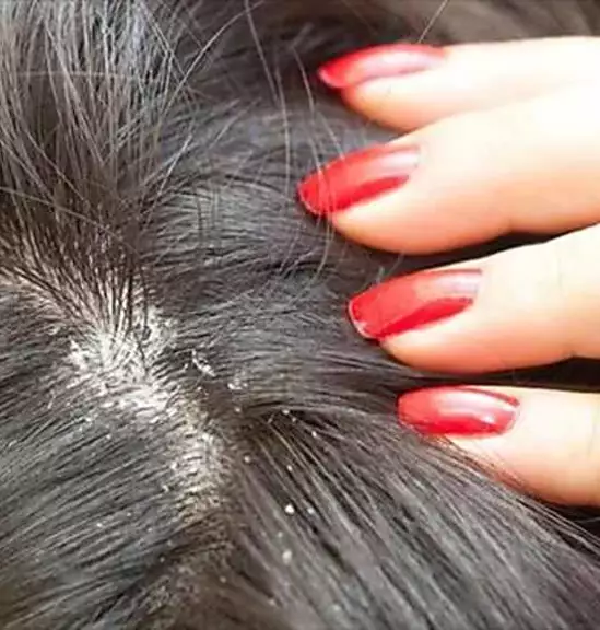 7 Simple Home Remedies to Prevent Hair Fall Due To Dandruff