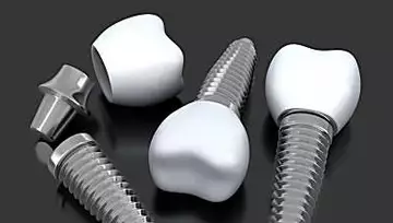 Δείτε ποια οδοντικά εμφυτεύματα πλήρους στόματος μπορεί να σας κοστίσουν.