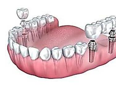Los precios de los implantes dentales de 2020 podrían sorprenderlo