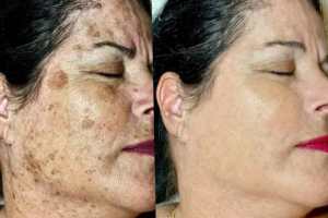 Surgeon Reveals: Don't Laser Dark Spots! (Use This Household Item Instead)