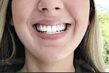 Famosa cantora revela que usou clareador dental caseiro e vira febre no Brasil