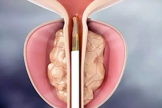 My secret to relieving prostatits symptoms